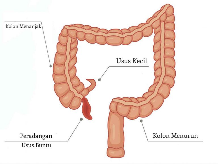 Usus Buntu Penyebab Gejala Dan Pengobatan Idn Medis