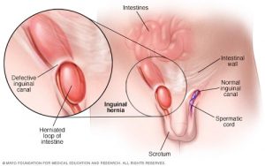 Hernia Gejala Penyebab Dan Cara Mengobati IDN Medis