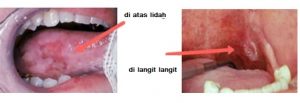 Kanker Mulut A-Z – Penyebab – Gejala – Pengobatan - IDN Medis