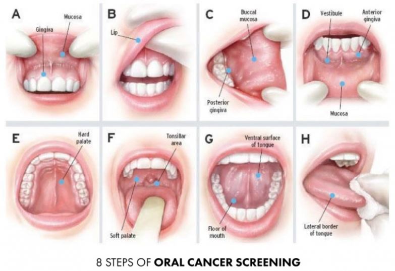 Kanker Mulut A-Z – Penyebab – Gejala – Pengobatan - IDN Medis
