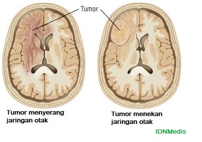Kanker Otak