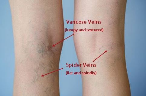 varicose veins dan spider veins