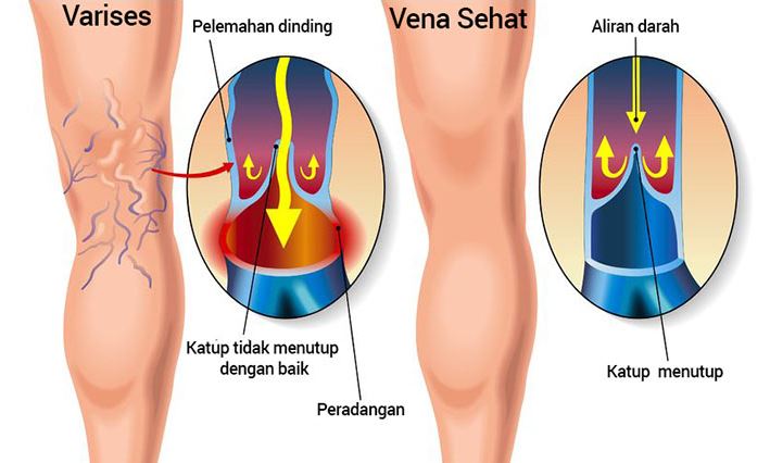 chirurgie vasculara varicoza vene