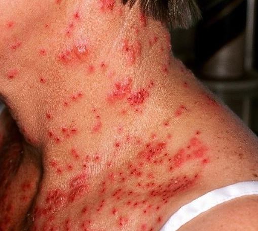 Herpes Penyebab Gejala Dan Cara Mengobati Idn Medis
