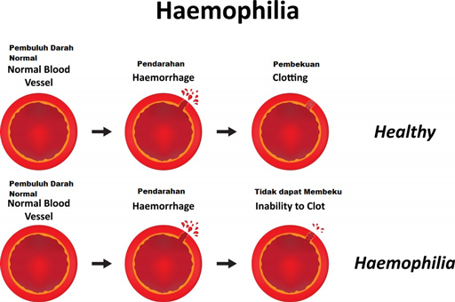 Hemofilia-B