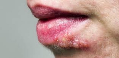 Herpes Oral (Orolabial Herpes)