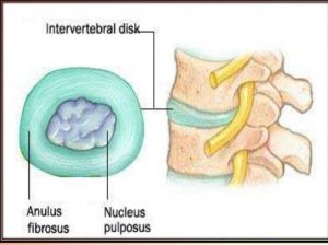 Hernia Nukleus Pulposus: Gejala, Penyebab Dan Cara Mengobati - IDN Medis