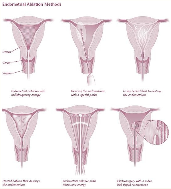 metode ablasi endometrium