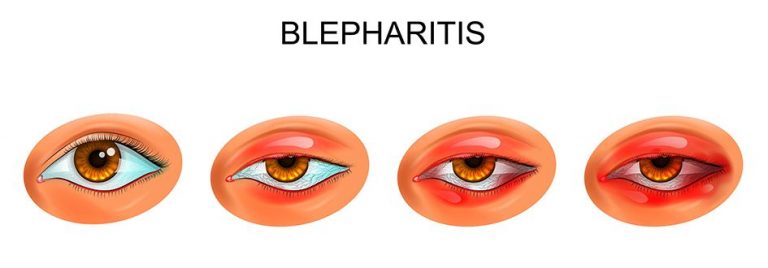 Blefaritis : Jenis – Penyebab Dan Pengobatan - IDN Medis