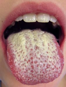 white and hairy tongue