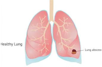 abses paru