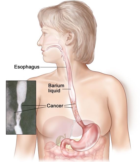 Barium Swallow Fungsi, Prosedur dan Efek Samping IDN Medis