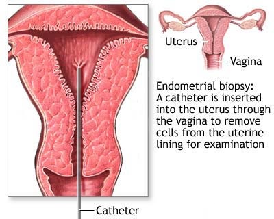 biopsi endometrium