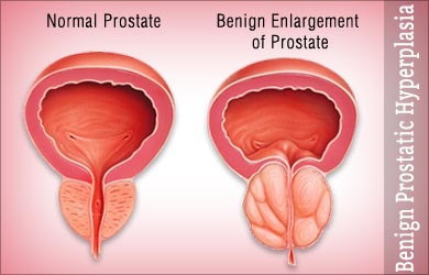 benigna hiperplazija prostate simptomi