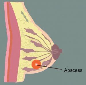 abses payudara