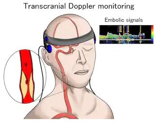 doppler transkranial