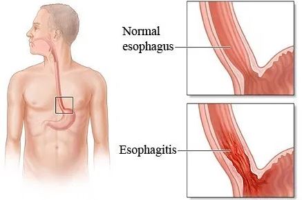 esofagitis
