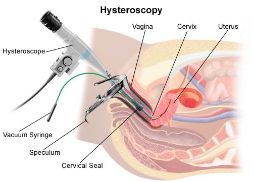 histeroskopi