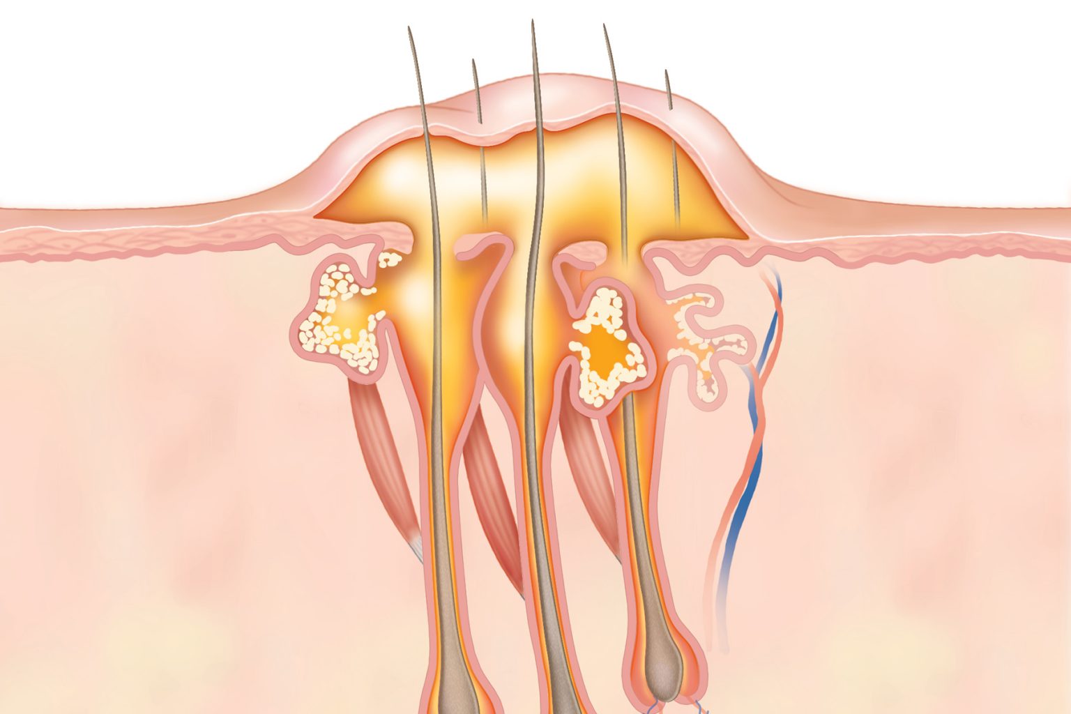 Ilustrasi bisul