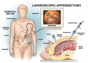 apendektomi laparoskopis
