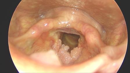 Juvenile laryngeal papilloma adalah