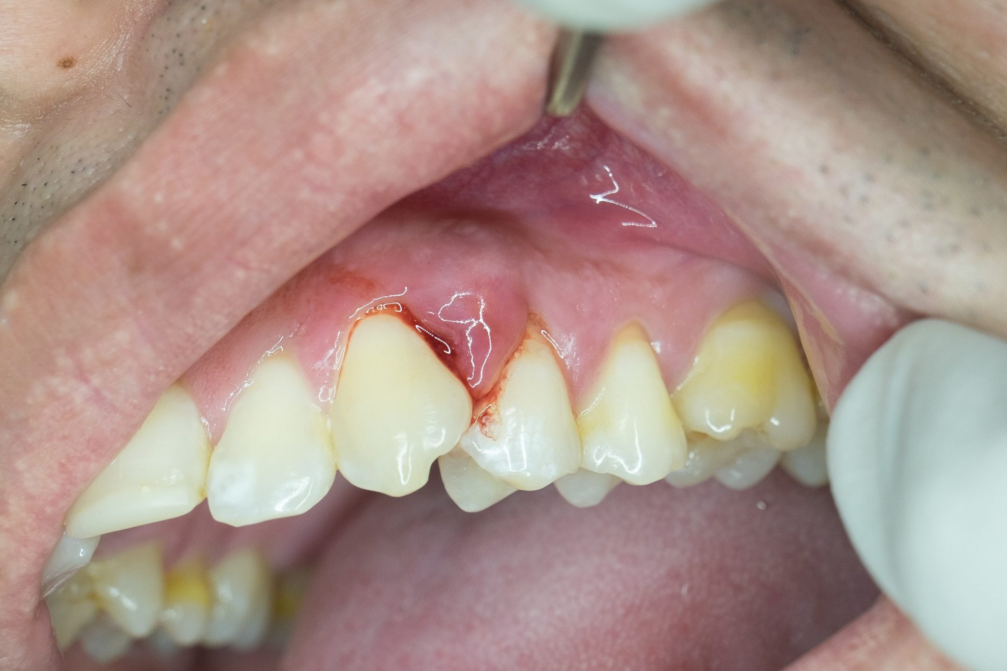 periodontitis-penyebab-gejala-dan-pengobatan-idn-medis