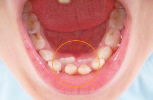 Supernumery Teeth atau gigi berlebih