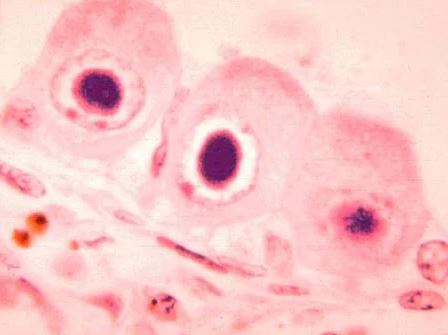 Penyakit Cytomegalovirus