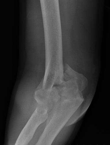 Understanding a Humerus Fracture