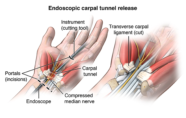 operasi endoskopik carpal tunnel