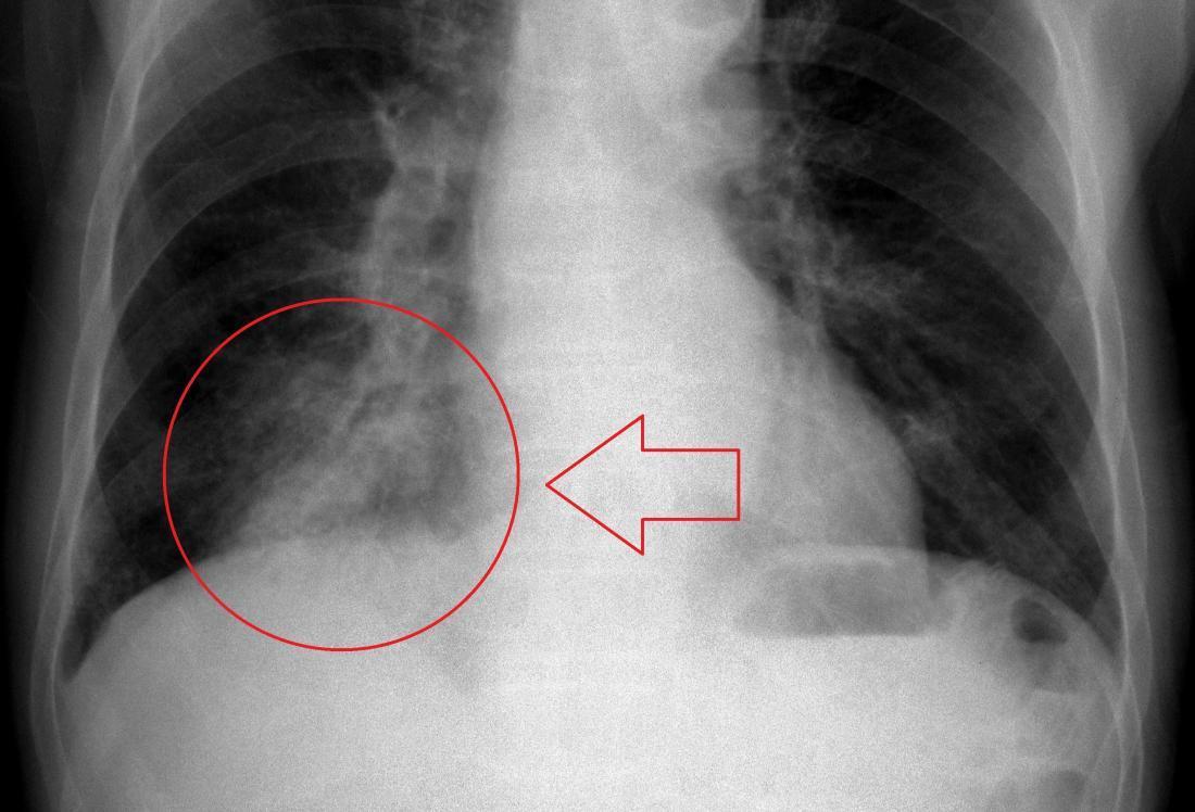 pneumonia-aspirasi-penyebab-gejala-dan-pengobatan-idn-medis