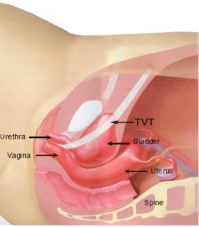 Pemasangan Tension Free Vaginal Tape (Tvt)