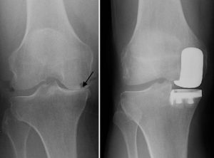 Penggantian Lutut Parsial