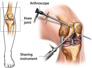 prosedur arthroscopy pada lutut