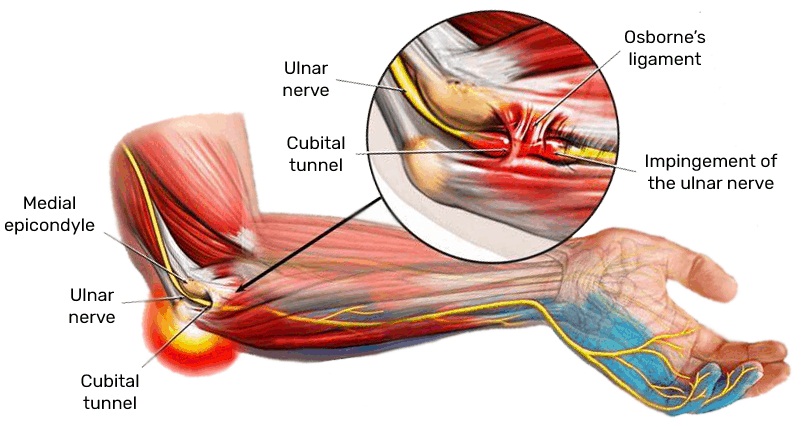 cubital tunnel syndrome