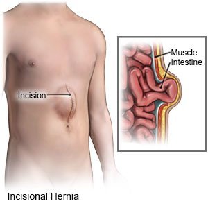 hernia insisional