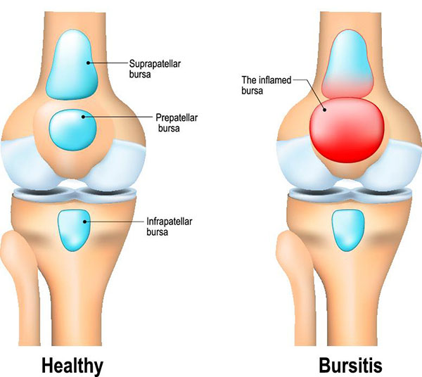 bursita suprapatelara tratament cum să tratezi inflamația ligamentelor genunchiului