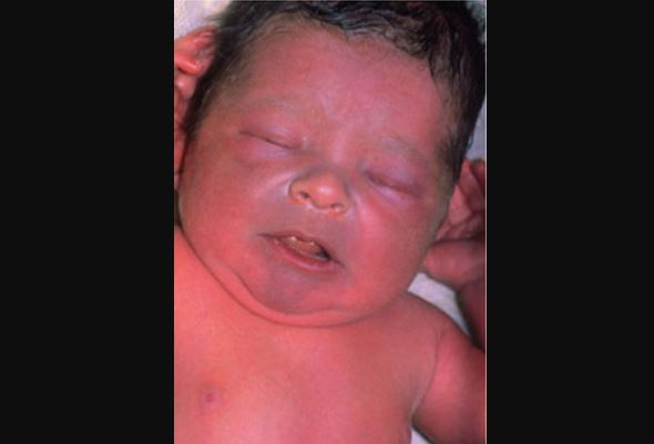 Infant Methemoglobinemia (Blue Baby Syndrome)
