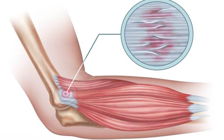 Tendinitis : Penyebab – Gejala dan Pengobatan - IDN Medis