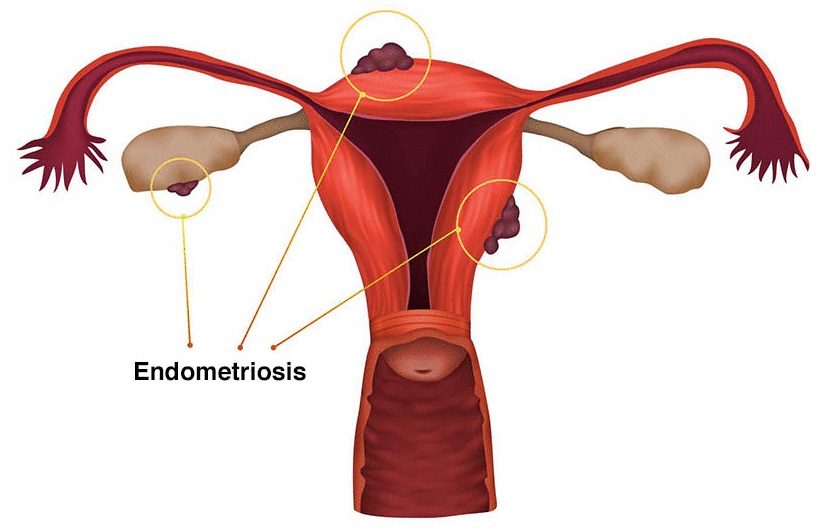 Penyakit endometriosis disebabkan oleh