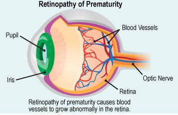 retinopati prematuritas