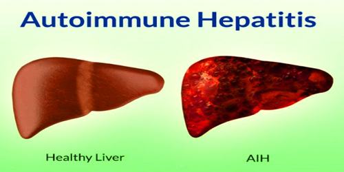 Hepatitis Autoimun