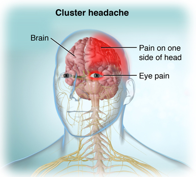 Sakit Kepala Cluster