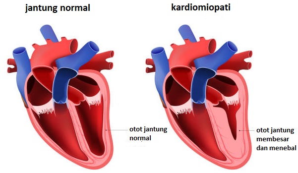 kardiomiopati