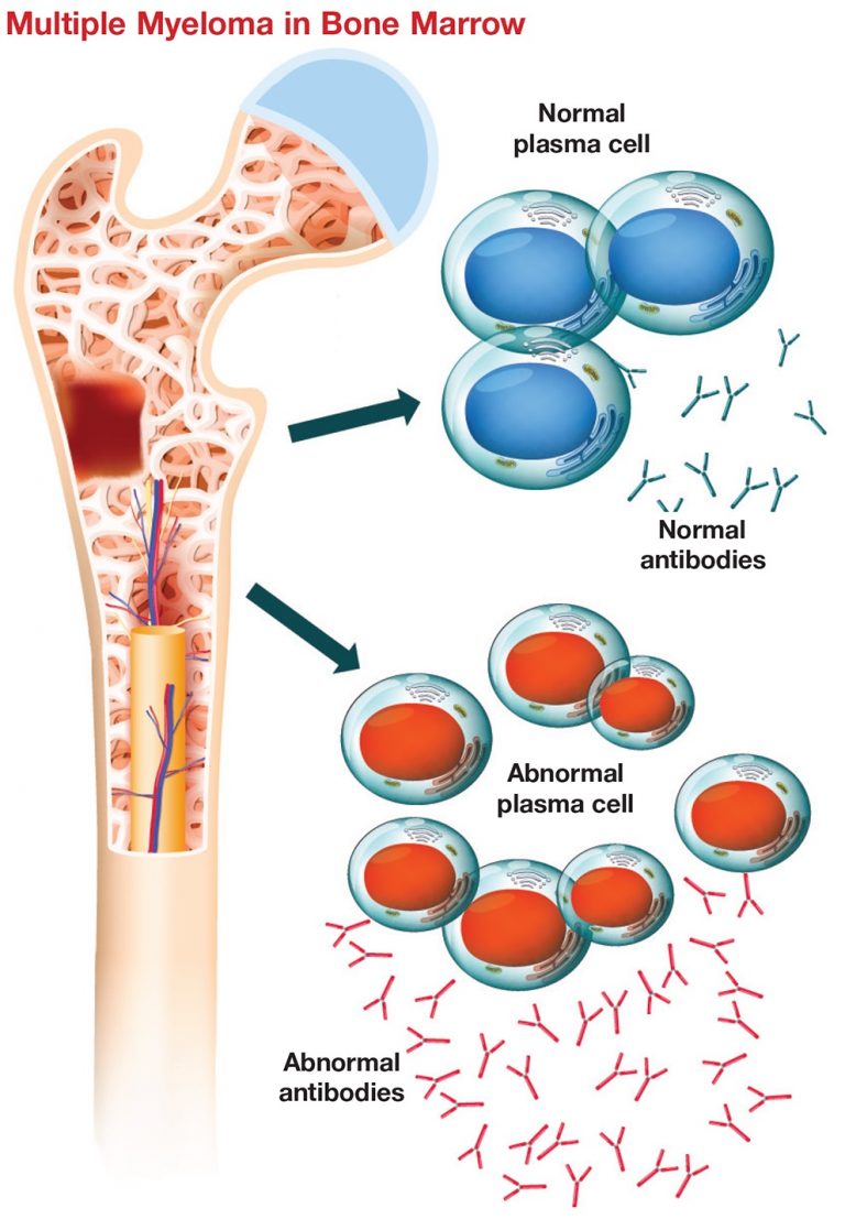 Multiple Myeloma Penyebab Gejala Dan Cara Mengobati Idn Medis 