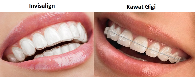 perbedaan invisalign dan kawat gigi