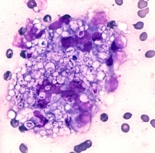 Histoplasmosis (infeksi jamur histoplasma capsulatum)