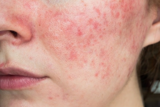 15 Jenis Penyakit Kulit dan Gambarnya - IDN Medis